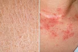 Natural Remedies for Eczema: What Works and What Doesn’t